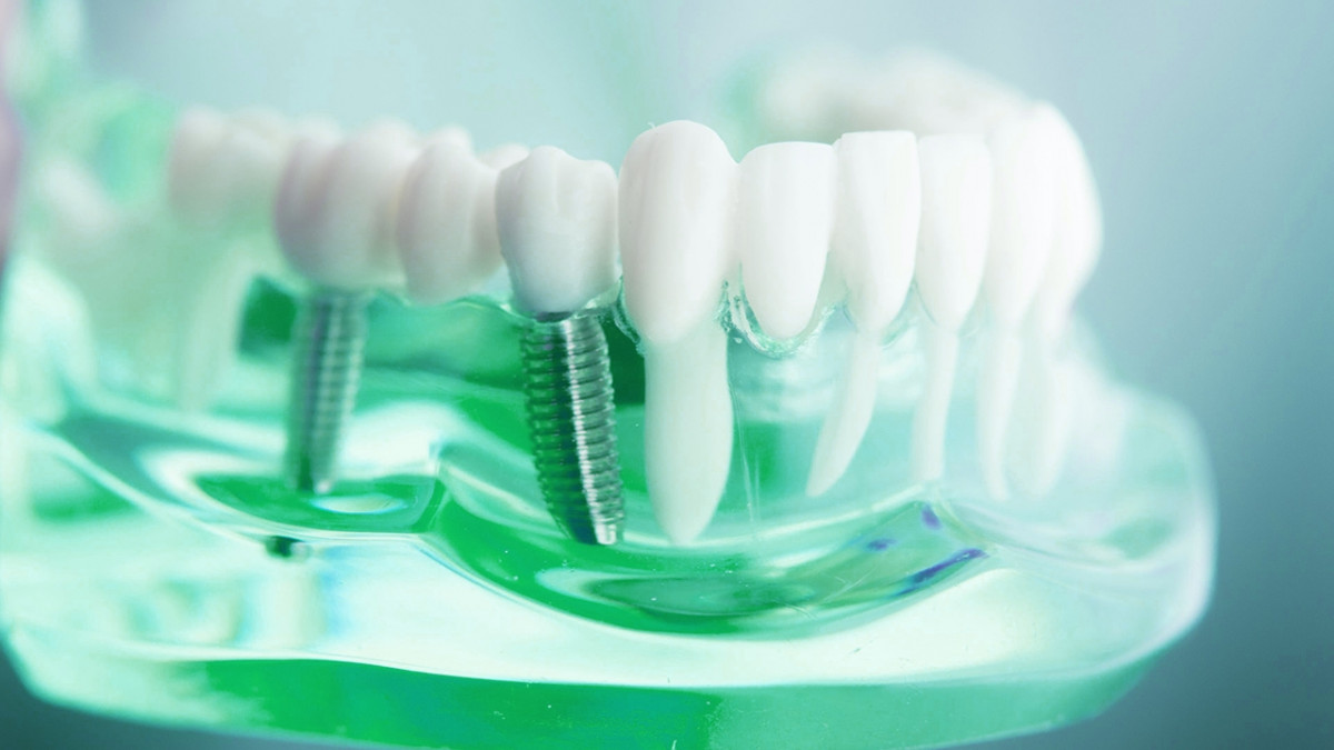 Implantaciya-zubov-cena